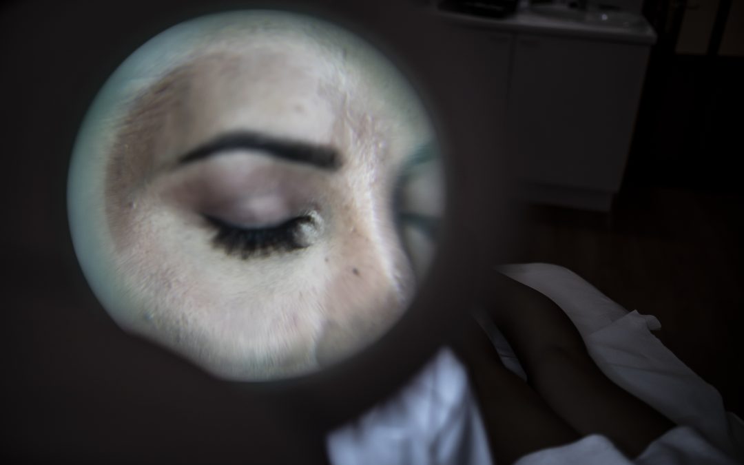 Luz pulsada intensa (IPL)